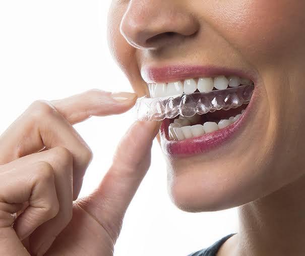 The Real Cost of Invisalign in Toronto (2026 Guide)