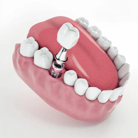 Same-Day Dental Implants: Are They Right for You?